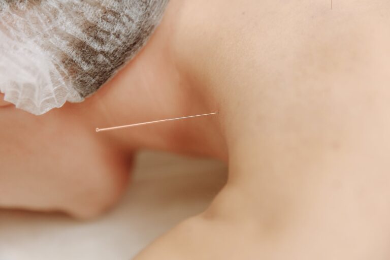 Manfaat Terapi di Klinik Akupuntur